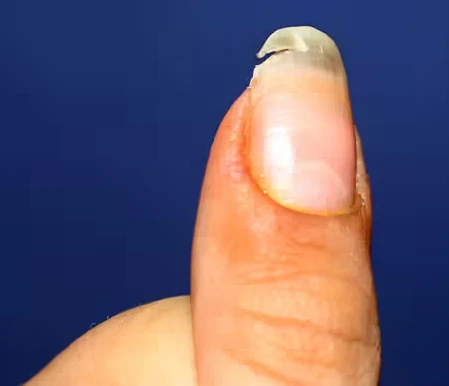 cracked nail